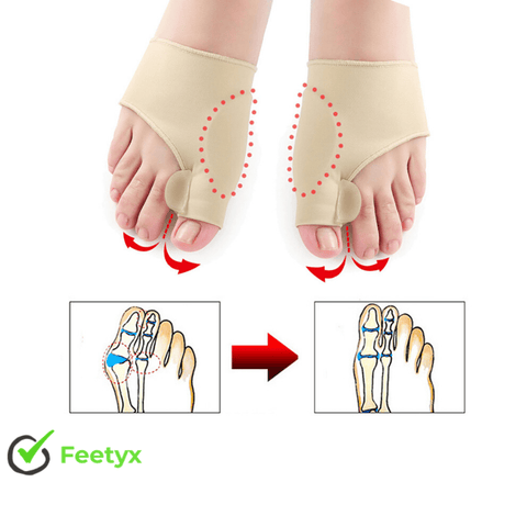 Feetyx™ | Correcteur orthopédique pour Hallux valgus